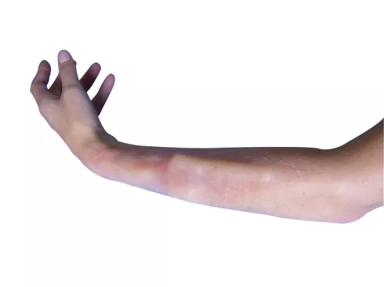 Simulation de fracture intérieure bras - avant bras - clavicule